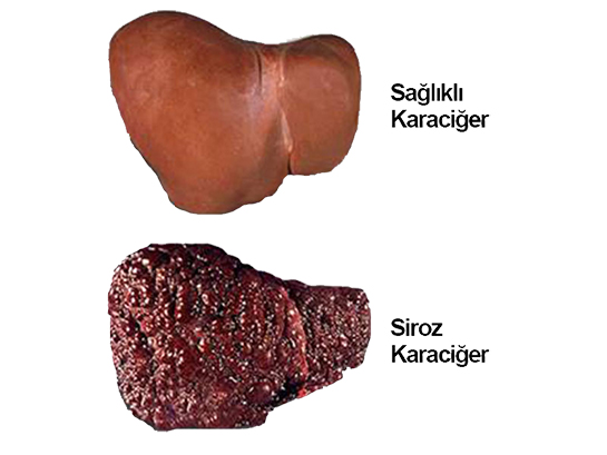 Karaciğer Hastalığı Karaciğer Hastalığı